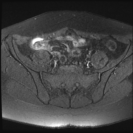 File:Adenomyosis-scar endometriosis (Radiopaedia 65863-75022 Axial T1 fat sat 4).jpg