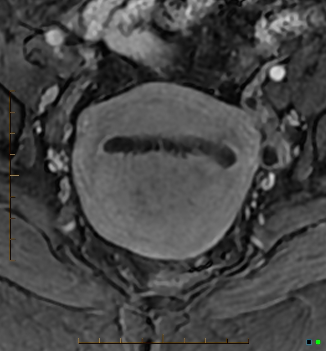 Adenomyosis uterus with hematometra (Radiopaedia 45779-50011 Axial T1 C+ fat sat 26).jpg