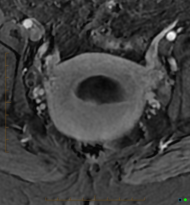 Adenomyosis uterus with hematometra (Radiopaedia 45779-50011 Axial T1 C+ fat sat 38).jpg