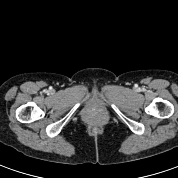 Adhesional small bowel obstruction (Radiopaedia 48397-53305 Axial C+ portal venous phase 101).jpg