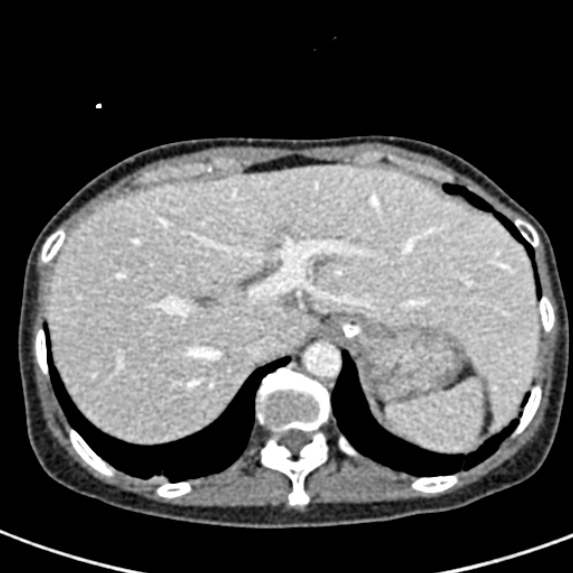 Adhesional small bowel obstruction (Radiopaedia 48397-53305 Axial C+ portal venous phase 9).jpg