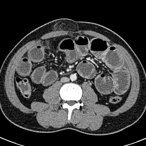 Adhesional small bowel obstruction (Radiopaedia 58900-66131 Axial C+ portal venous phase 28).jpg