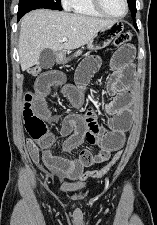 Adhesional small bowel obstruction (Radiopaedia 58900-66131 Coronal C+ portal venous phase 105).jpg