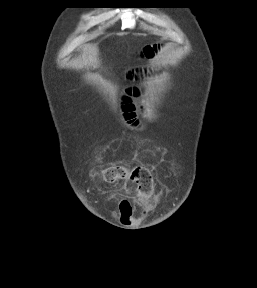 Adhesions within abdominal wall hernia (Radiopaedia 58283-65394 Coronal C+ portal venous phase 10).png