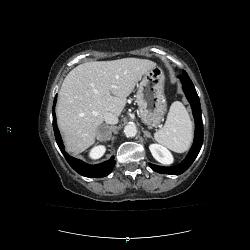 File:Adrenal collision tumor (ACT) (Radiopaedia 48462-53379 Axial C+ portal venous phase 11).jpg
