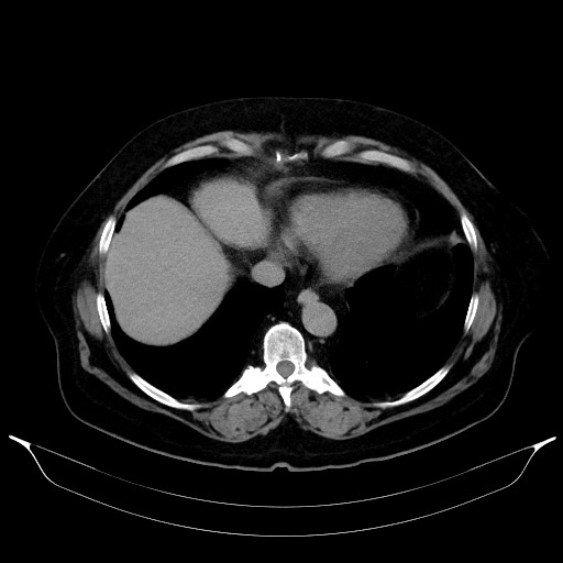 File:Adrenal cortical carcinoma (Radiopaedia 64017-72769 Axial C+ delayed 9).jpg