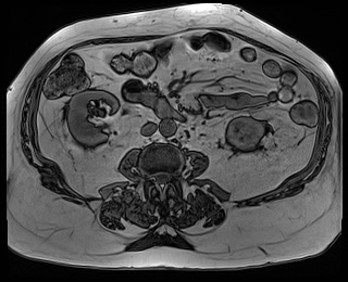 File:Adrenal cortical carcinoma (Radiopaedia 64017-72770 Axial T1 out-of-phase 53).jpg