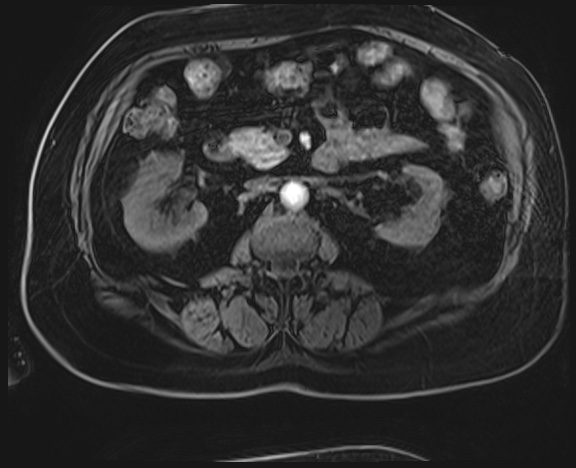 Adrenal cortical carcinoma (Radiopaedia 64017-72770 H 24).jpg