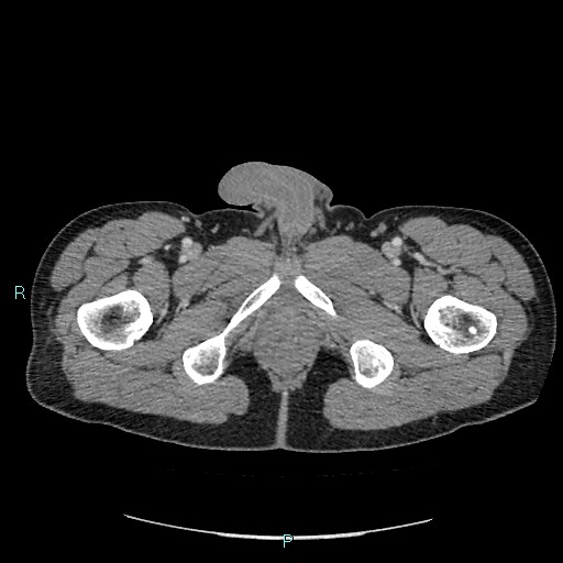 Adrenal cystic lymphangioma (Radiopaedia 83161-97534 Axial C+ portal venous phase 107).jpg