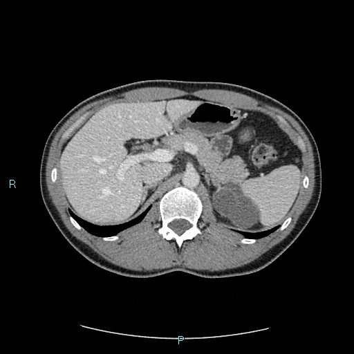 File:Adrenal cystic lymphangioma (Radiopaedia 83161-97534 Axial C+ portal venous phase 29).jpg