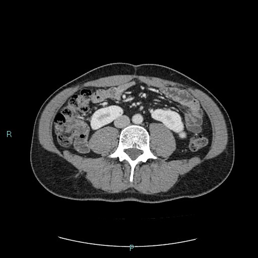 Adrenal cystic lymphangioma (Radiopaedia 83161-97534 Axial C+ portal venous phase 56).jpg