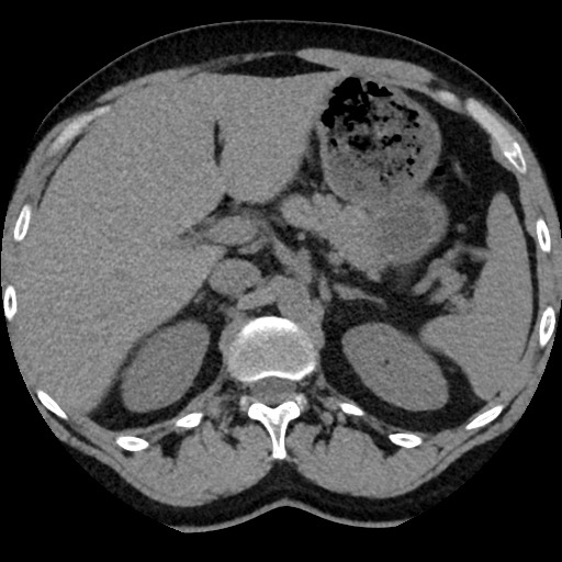 Adrenal gland trauma (Radiopaedia 81351-95079 Axial non-contrast 32).jpg