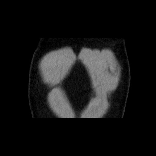Adrenal gland trauma (Radiopaedia 81351-95079 Coronal non-contrast 11).jpg