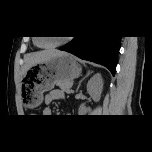 Adrenal gland trauma (Radiopaedia 81351-95079 Sagittal non-contrast 66).jpg