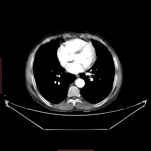 File:Adrenal hemangioma (Radiopaedia 68923-78668 Axial C+ arterial phase 6).jpg