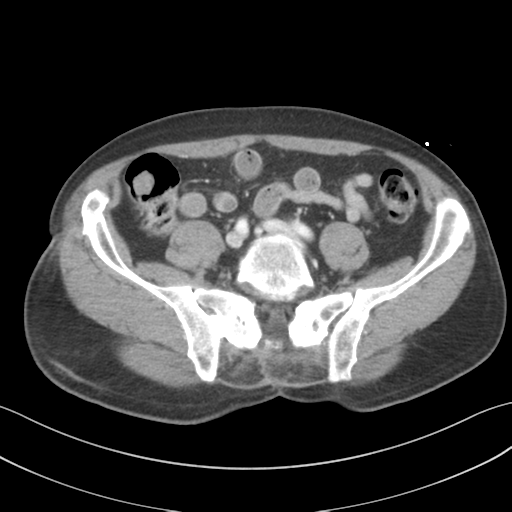 File:Adrenal hematoma (Radiopaedia 44334-47968 Axial C+ portal venous phase 57).png
