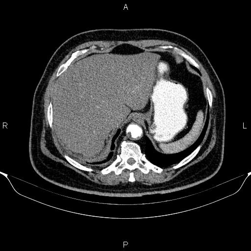 Adrenal hemorrhage (Radiopaedia 62622-70916 Axial C+ arterial phase 52).jpg