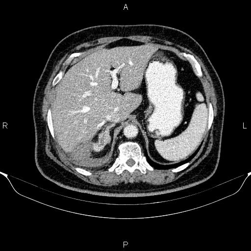 Adrenal hemorrhage (Radiopaedia 62622-70916 Axial C+ portal venous phase 36).jpg