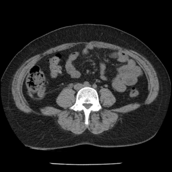 Adrenal myelolipoma (Radiopaedia 43401-46759 Axial non-contrast 52).jpg