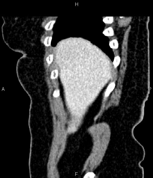 Adrenal myelolipoma (Radiopaedia 82742-96986 Sagittal renal cortical phase 18).jpg