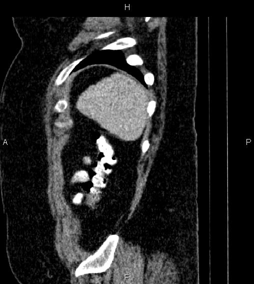 Adrenal myelolipoma (Radiopaedia 84319-99617 Sagittal renal cortical phase 89).jpg