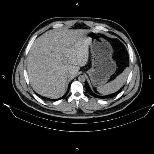 Adrenal myelolipoma (Radiopaedia 84321-99619 Axial non-contrast 22).jpg