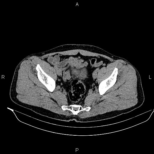 Adrenal myelolipoma (Radiopaedia 87794-104246 Axial non-contrast 91).jpg