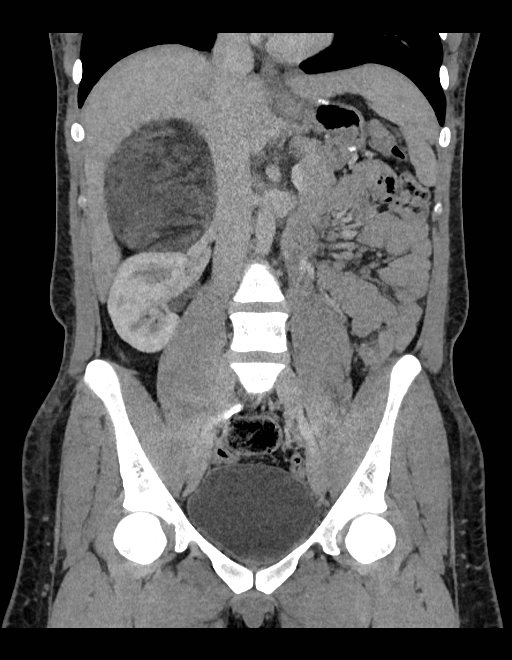 Adrenal myelolipoma - bilateral (Radiopaedia 74805-85810 Coronal C+ portal venous phase 156).jpg