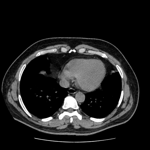 Adrenal myelolipoma and beaver tail liver (Radiopaedia 86201-102193 Axial non-contrast 4).jpg