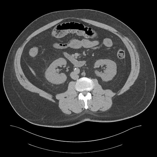 File:Adrenal vein sampling and adrenal nodular hyperplasia - Conn syndrome (Radiopaedia 30561-31337 Axial non-contrast 46).jpg