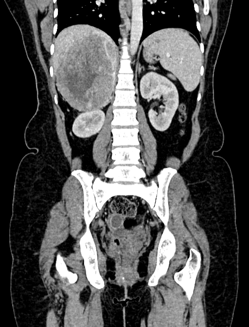 Adrenocortical carcinoma (Radiopaedia 87281-103569 Coronal C+ portal venous phase 83).jpg