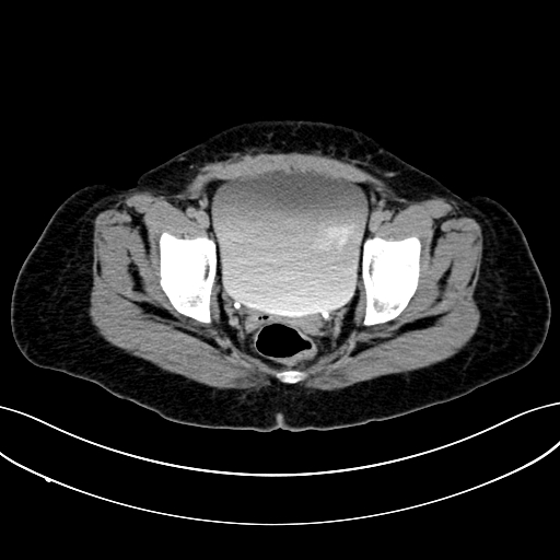 File:Adrenocortical carcinoma (Radiopaedia 87281-103569 Sagittal C+ portal venous phase 121).jpg