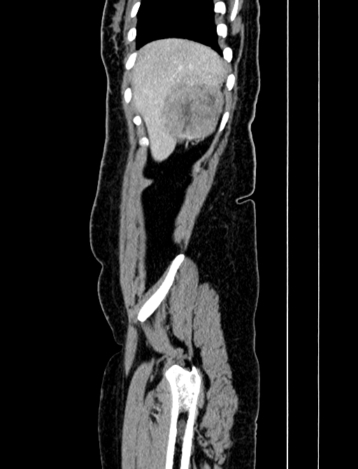 Adrenocortical carcinoma (Radiopaedia 87281-103569 Sagittal C+ portal venous phase 20).jpg