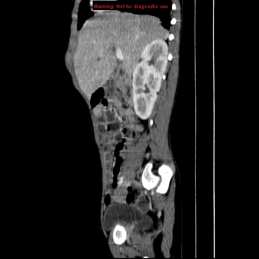 File:Adrenocortical carcinoma (Radiopaedia 9449-10131 Sagittal C+ portal venous phase 1).jpg