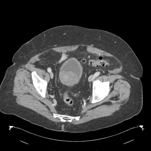 Adult ileal intussusception with secondary obstruction (Radiopaedia 30395-31051 Axial C+ portal venous phase 67).jpg