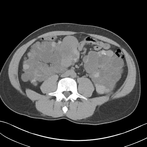 Adult polycystic kidney disease (Radiopaedia 47866-52626 Axial non-contrast 46).png