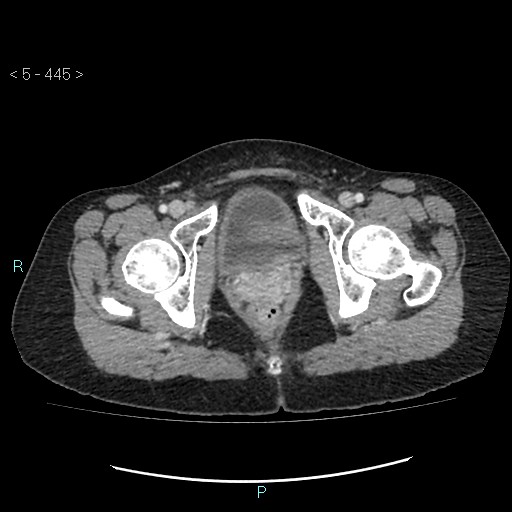 Adult transient intestinal intussusception (Radiopaedia 34853-36310 Axial C+ portal venous phase 119).jpg