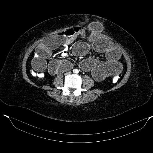 Afferent loop syndrome - secondary to incarcerated trocar site hernia (Radiopaedia 82959-97305 Axial C+ portal venous phase 142).jpg