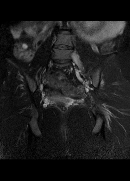 File:Aggressive angiomyxoma of the pelvis and perineum (Radiopaedia 59162-66479 Coronal T2 fat sat 19).jpg