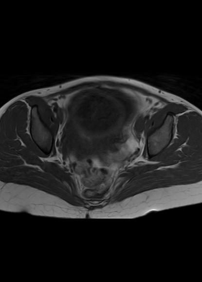 File:Aggressive angiomyxoma of the pelvis and perineum (Radiopaedia 59162-66479 T1 15).jpg