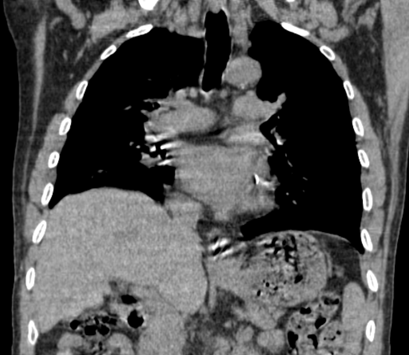 Airway foreign body in adult (Radiopaedia 85907-101779 Coronal liver window 133).jpg