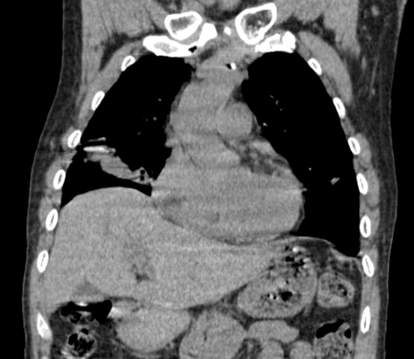 Airway foreign body in adult (Radiopaedia 85907-101779 Coronal liver window 86).jpg
