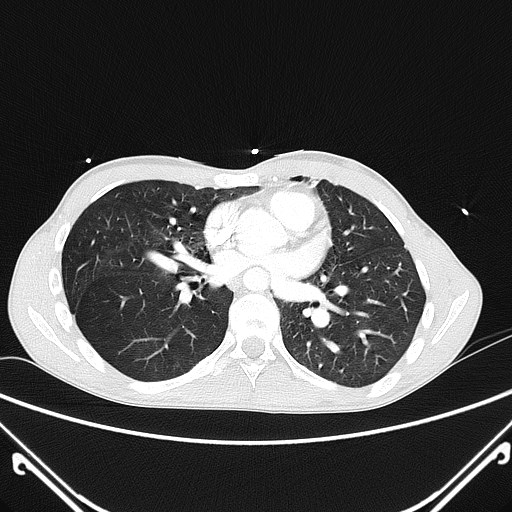 File:Alagille syndrome with pulmonary hypertension (Radiopaedia 49384-54980 Axial lung window 4).jpg