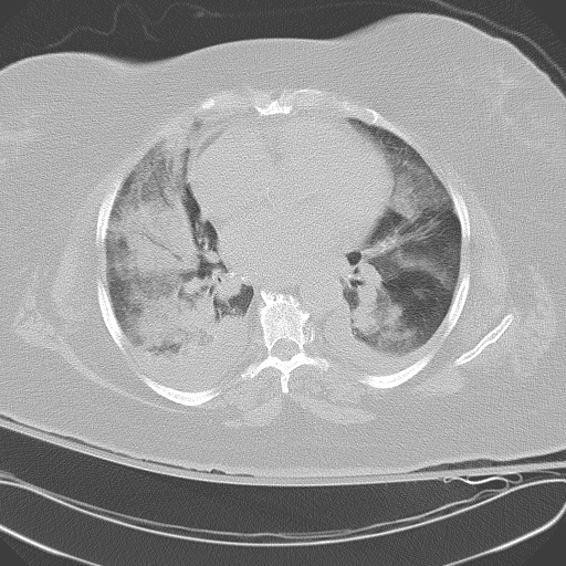 All trans retinoic acid (ATRA) syndrome (Radiopaedia 38212-40229 Axial lung window 31).jpg