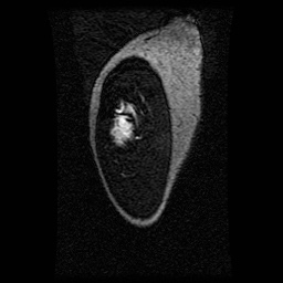Alveolar soft part sarcoma (Radiopaedia 64501-73678 D 126).jpg