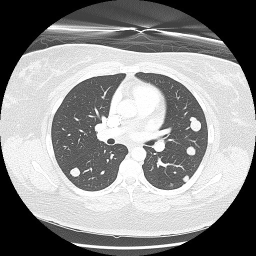 Alveolar soft part sarcoma - right leg (Radiopaedia 59432-67091 Axial lung window 51).jpg