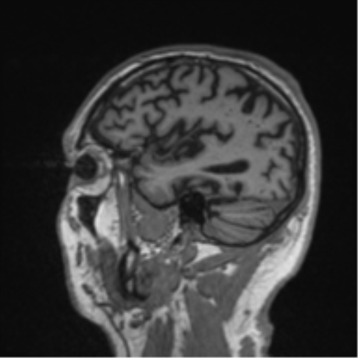 Alzheimer's disease- with Gerstmann syndrome and dressing apraxia (Radiopaedia 54882-61150 Sagittal T1 56).png