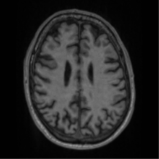Alzheimer's disease- with apraxia (Radiopaedia 54763-61011 Axial T1 50).png