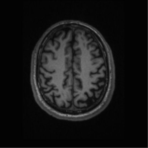 Alzheimer disease - probable (Radiopaedia 35334-36837 Axial T1 55).png
