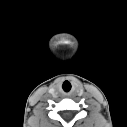 File:Ameloblastoma (Radiopaedia 26645-26793 Axial C+ delayed 3).jpg